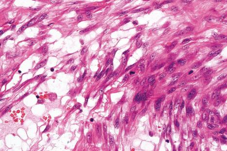 Fig. 35.68, Dermal fasciitis: normal mitoses are often present.