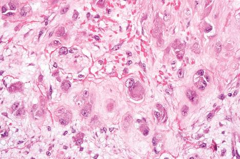 Fig. 35.70, Proliferative fasciitis: the ganglion-like cells have abundant eosinophilic cytoplasm and large vesicular nuclei containing prominent nucleoli.