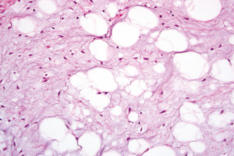 Fig. 35.7, Myxofibrolipoma: note the abundant mucinous matrix and spindled cells admixed with adipocytes.