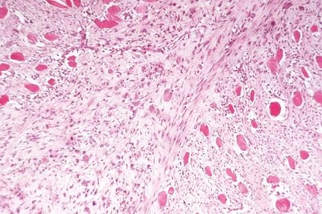 Fig. 35.71, Proliferative myositis: the muscle fibers are separated by a cellular infiltrate, giving a ‘checkerboard’ appearance.