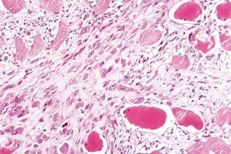 Fig. 35.72, Proliferative myositis: the giant cells have abundant cytoplasm and contain large vesicular nuclei with prominent intensely eosinophilic nucleoli.