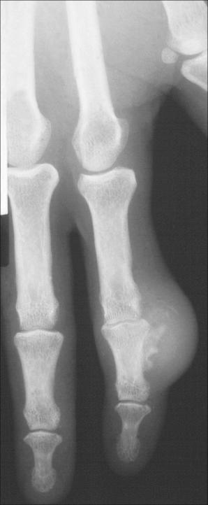 Fig. 35.73, Fibro-osseous pseudotumor of the digits: this lesion presented as a rapidly growing nodule. Note the prominent calcification.