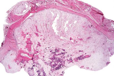 Fig. 35.74, Fibro-osseous pseudotumor of the digits: scanning view showing osteoid, foci of calcification and a myxoid spindle cell tumor.