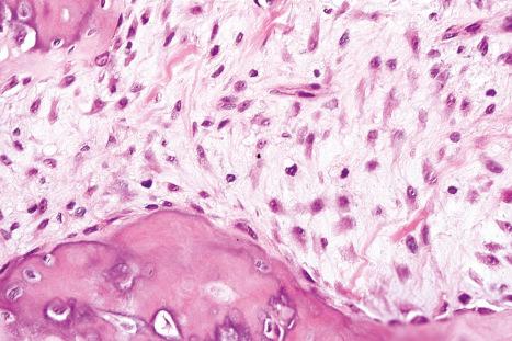 Fig. 35.76, Fibro-osseous pseudotumor of the digits: high-power view of tumor myofibroblasts.