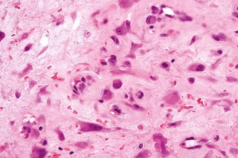 Fig. 35.79, Ischemic fasciitis: there are atypical spindled cells and histiocyte-like cells, some with a ganglion-like appearance.