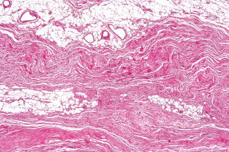 Fig. 35.80, Elastofibroma: there is an admixture of collagen bundles and thickened, irregular, eosinophilic elastic fibers.