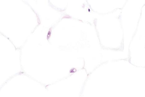 Fig. 35.8, Lipoma: intranuclear lipid ‘inclusions’ (lochkern) should not be mistaken for lipoblasts.