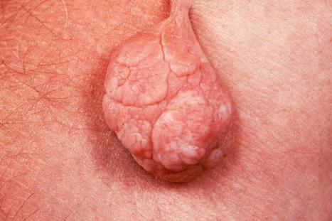 Fig. 35.83, Acrochordon: also known as a skin tag or fibroepithelial polyp, this soft polyp is exceedingly common.