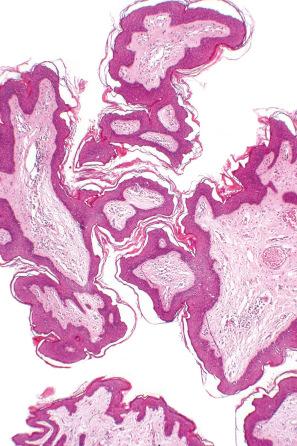 Fig. 35.84, Acrochordon: histologically, it consists of connective tissue covered by squamous epithelium.