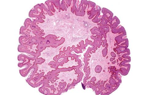 Fig. 35.85, Acrochordon: this unusually sectioned example shows the features to advantage.