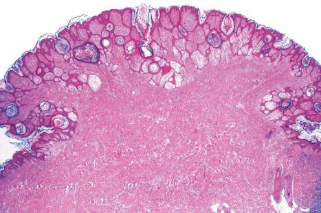 Fig. 35.86, Pleomorphic fibroma: this lesion is characterized by the presence of scattered mononuclear and multinucleated giant cells.