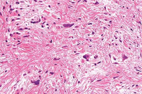 Fig. 35.87, Pleomorphic fibroma: note the fusiform and stellate cells with hyperchromatic irregular nuclei.