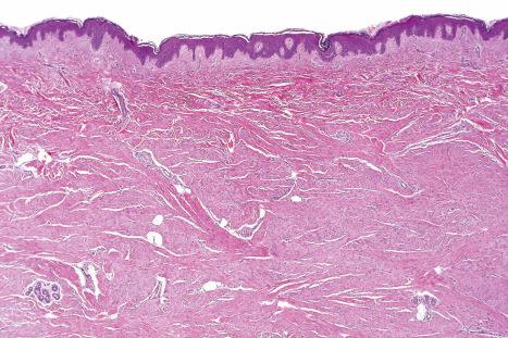 Fig. 35.88, Dermatomyofibroma: low-power view showing fascicles of spindled cells orientated parallel to the surface epithelium.