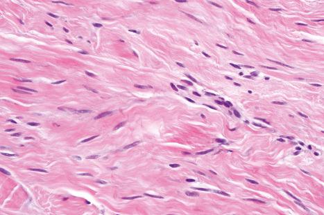 Fig. 35.90, Dermatomyofibroma: the tumor cells have eosinophilic cytoplasm and regular elongated nuclei.