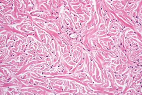 Fig. 35.93, Storiform collagenoma: high-power view.