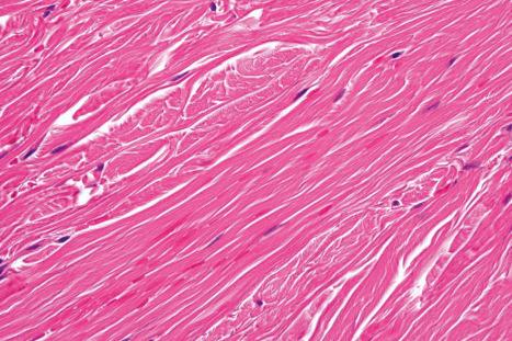 Fig. 35.96, Nuchal fibroma: high-power view.