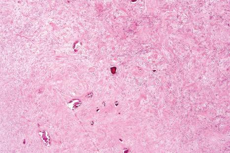 Fig. 35.97, Calcifying fibrous tumor: this example shows a relatively hypocellular tumor. Note the focal calcification.