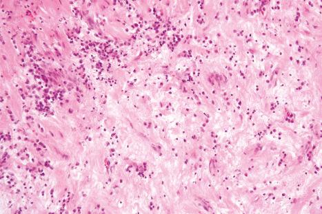 Fig. 35.98, Calcifying fibrous tumor: note the inflammatory cell infiltrate, which is often a feature of this tumor.