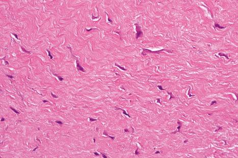 Fig. 35.100, Fibroma of tendon sheath: high-power view showing scattered myofibroblasts.