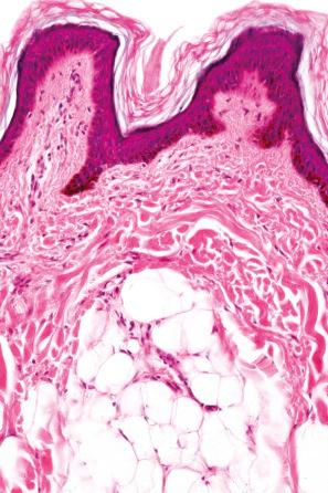 Fig. 35.10, Dermal lipoma: it is often separated from the epidermis by a grenz zone.