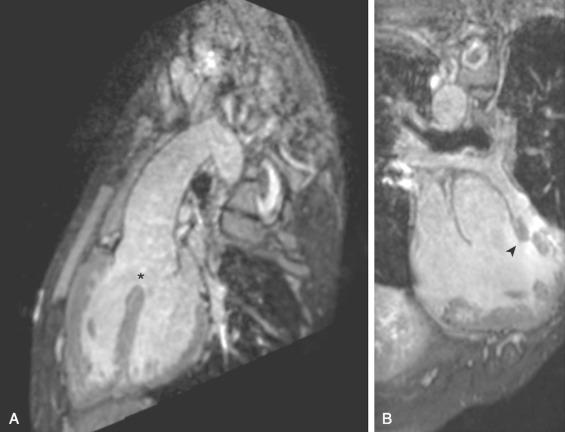 Figure 75.1, Unrepaired tetralogy of Fallot in an 18-year-old.