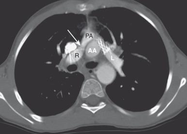 e-Figure 75.14, {S,D,D} transposition of the great arteries after the arterial switch procedure complicated by pulmonary stenoses.