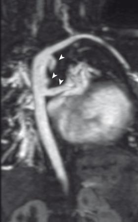 e-Figure 75.2, Tetralogy of Fallot and pulmonary atresia in a 2-month-old girl.