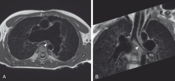 e-Figure 75.3, Tetralogy of Fallot and an absent pulmonary valve after repair with a transannular patch in a 5-year-old boy.