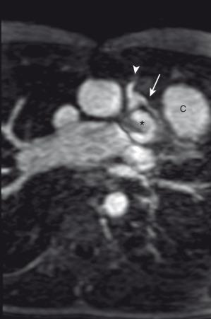 e-Figure 75.4, Tetralogy of Fallot in a 14-year-old boy.