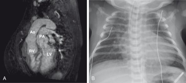 Figure 75.7, {S,D,D} transposition of the great arteries (TGA).