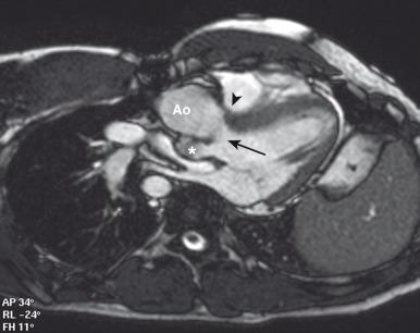 e-Figure 75.10, {S,D,D} transposition of the great arteries, a ventricular septal defect, and pulmonary stenosis after the Rastelli procedure in a 22-year-old man.