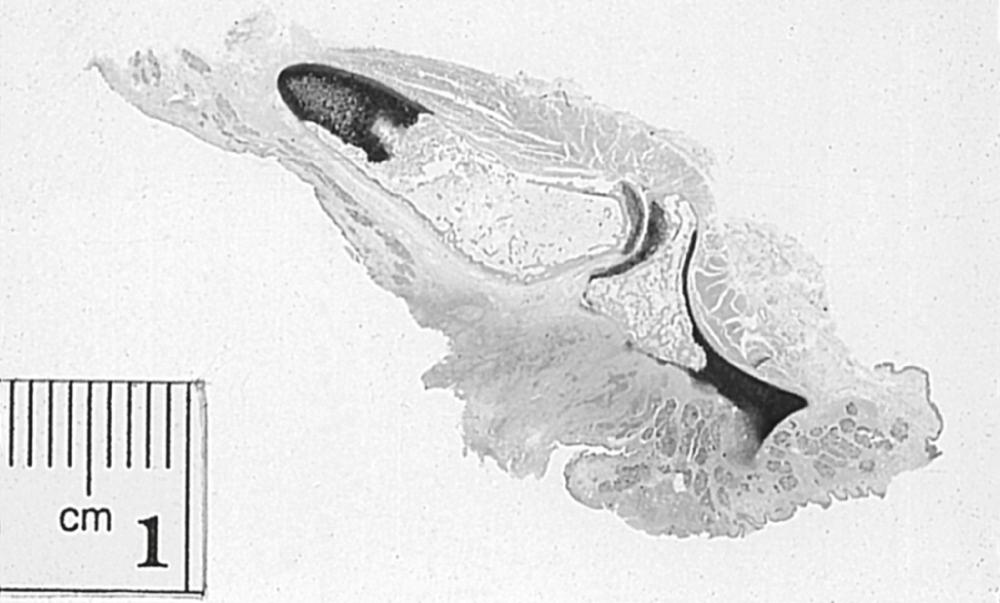 Fig. 108.8, Entire section through the cricoarytenoid joint with fixation of the true cord and the arytenoid, which reveals cricoarytenoid joint invasion.