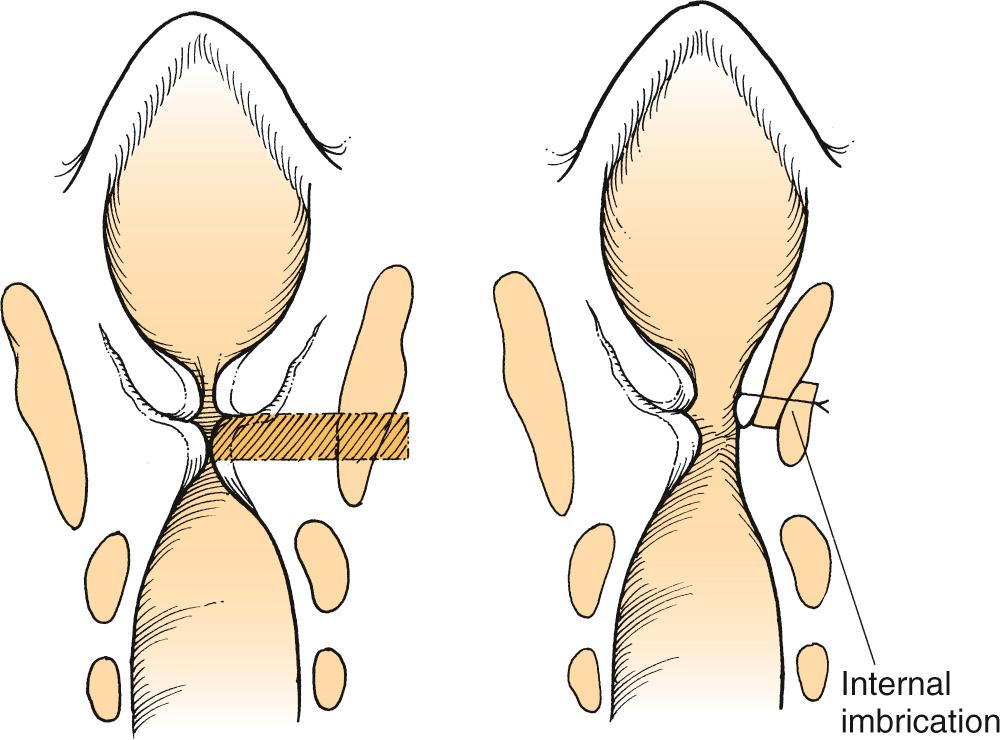 Fig. 108.9, Imbrication laryngoplasty, reconstructive technique.