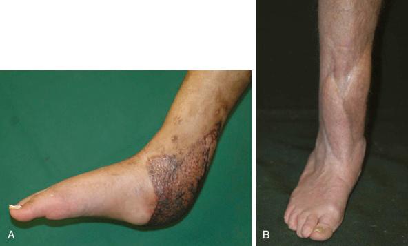 Figure 3.2, (A) Although the bulk and contour of this latissimus dorsi muscle free flap used to cover the degloved plantar and posterior hindfoot was acceptable, the final appearance after the necessary skin graft was not ideal. (B) This can be compared with metachronous bilateral anterolateral thigh free flaps used to cover complications of an open distal tibial fracture, where both blend almost imperceptibly into each other and the surrounding lower limb to give a superior appearance.