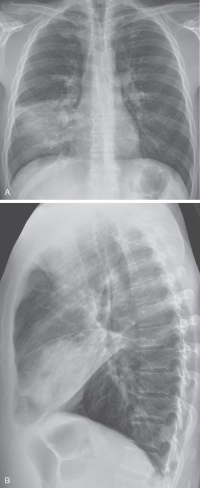 Fig. 2.1, Parenchymal consolidation and silhouette sign from middle lobe pneumonia. (A) Posteroanterior chest radiograph showing consolidation in the right lower lung zone. Note obscuration of the right heart border (silhouette sign), consistent with consolidation in the right middle lobe. The dome of the right hemidiaphragm is clearly seen, consistent with sparing of the basal segments of the lower lobes. (B) Lateral chest radiograph showing dense consolidation in the right middle lobe.