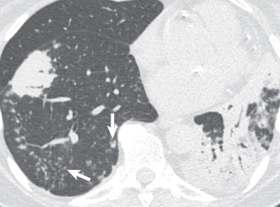 Fig. 2.11, Adenocarcinoma. Axial image from noncontrast chest CT shows left greater than right multifocal lung consolidation with air bronchograms. Mild centrilobular and tree-in-bud nodularity (arrows) in the right lower lobe is consistent with aerogenous spread of cancer.