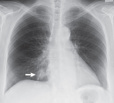 Fig. 2.12, Primary pulmonary lymphocytic MALT lymphoma of the lung. Posteroanterior chest radiograph showing focal consolidation in the right lower lung zone (arrow). Note the focal obliteration of the right heart border (silhouette sign) at the level of the consolidation indicating origin in the middle lobe.