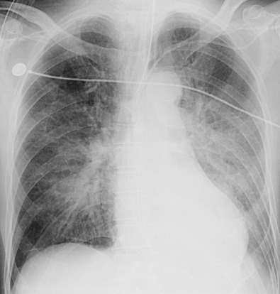 Fig. 2.13, Hydrostatic pulmonary edema from left heart failure. A posteroanterior chest radiograph shows extensive consolidation with relative sparing of the subpleural regions. A central venous catheter and an endotracheal tube are in place.