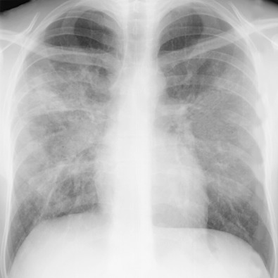 Fig. 2.14, Pneumocystis jirovecii pneumonia in the setting of AIDS. A posteroanterior chest radiograph shows bilateral areas of consolidation and ground-glass opacities in a predominantly perihilar distribution.