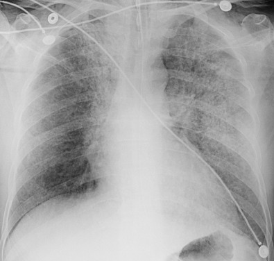 Fig. 2.16, Diffuse pulmonary hemorrhage in granulomatosis with polyangiitis. An anteroposterior chest radiograph shows extensive bilateral areas of consolidation and ground-glass opacities. Endotracheal and nasogastric tubes are in place.