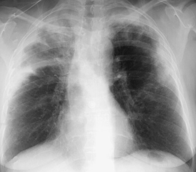 Fig. 2.17, Chronic eosinophilic pneumonia. A posteroanterior chest radiograph shows bilateral areas of consolidation involving the peripheral regions of the upper and middle lung zones.