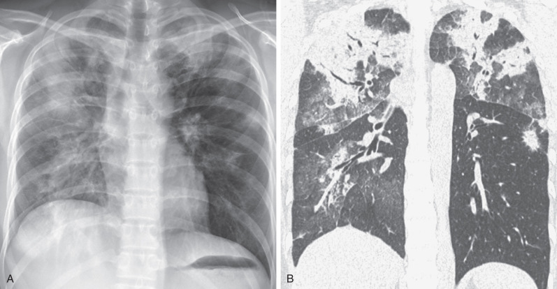 Fig. 2.18, Cryptogenic organizing pneumonia. (A) Posteroanterior chest radiograph showing bilateral multifocal and confluent consolidation involving mainly the upper lobes. (B) A coronal reformatted CT image shows a predominant peribronchial and peripheral distribution of the consolidation.