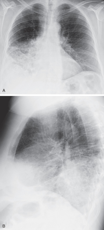 Fig. 2.2, Parenchymal consolidation and the silhouette sign in right middle and lower lobe pneumonia. (A) Posteroanterior chest radiograph showing parenchymal consolidation in the right lower lung zone with obscuration of the silhouettes of the right heart border and the right hemidiaphragm. (B) Lateral chest radiograph confirming the presence of consolidation in the right middle lobe, which accounts for obscuration of the right heart border on the frontal view, and consolidation in the lower lobe, which obscures the silhouette of the right hemidiaphragm. The left hemidiaphragm is clearly seen as outlined by lung on both the frontal and lateral views.