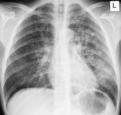 Fig. 2.4, Multifocal consolidation in bronchopneumonia. Posteroanterior chest radiograph showing patchy consolidation in the left upper and lower lobes. Note the inhomogeneous increased opacity of the left heart compared with the region of the right atrium, consistent with consolidation in the retrocardiac region of the left lower lobe.