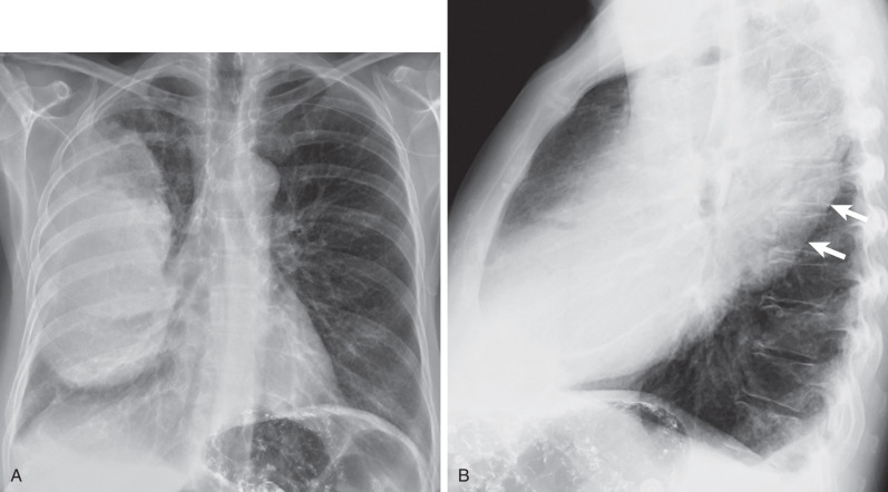 Fig. 2.5, Severe pneumonia with lobar expansion and the “bulging fissure sign.” (A) Posteroanterior chest radiograph showing dense consolidation in the right upper and middle lobes. (B) Lateral chest radiograph demonstrating posterior convexity of the major fissure (arrows) (bulging fissure sign), characteristic of lobar expansion. Also noted are a small right pleural effusion and residual barium in the splenic flexure.