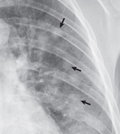 Fig. 2.6, Airspace nodules. A magnified view of the left upper lobe in a patient with bronchopneumonia (same patient as in Fig. 2.4 ) shows several round opacities with poorly defined margins (arrows). These opacities represent airspace nodules and have been shown to histologically reflect the presence of peribronchiolar (centrilobular) consolidation.