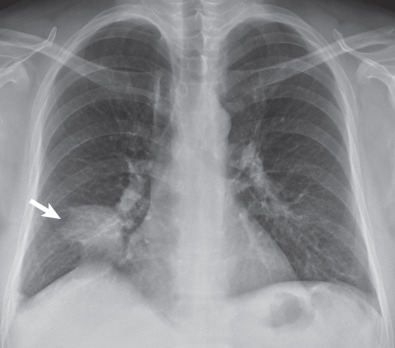 Fig. 2.7, Round pneumonia. Posteroanterior chest radiograph showing a round mass-like area of consolidation (arrow) in the right middle lobe .