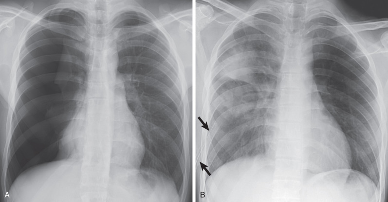 Fig. 2.8, Reexpansion pulmonary edema. (A) Posteroanterior chest radiograph showing a large right pneumothorax. (B) A chest radiograph 36 hours after insertion of a right chest tube (arrows) shows areas of consolidation and extensive hazy areas of increased opacity (ground-glass opacities) in the right lung consistent with reexpansion pulmonary edema.