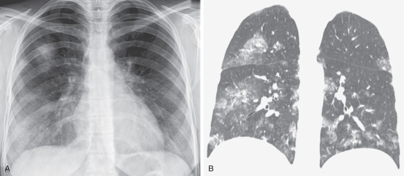 Fig. 2.9, Multifocal consolidation in diffuse pulmonary hemorrhage in granulomatosis with polyangiitis. (A) Posteroanterior chest radiograph showing dense consolidation in the right upper lobe and poorly defined areas of consolidation and ground-glass opacities in the lower lung zones. (B) Coronal reformatted CT image demonstrating multifocal areas of consolidation and ground-glass opacities.