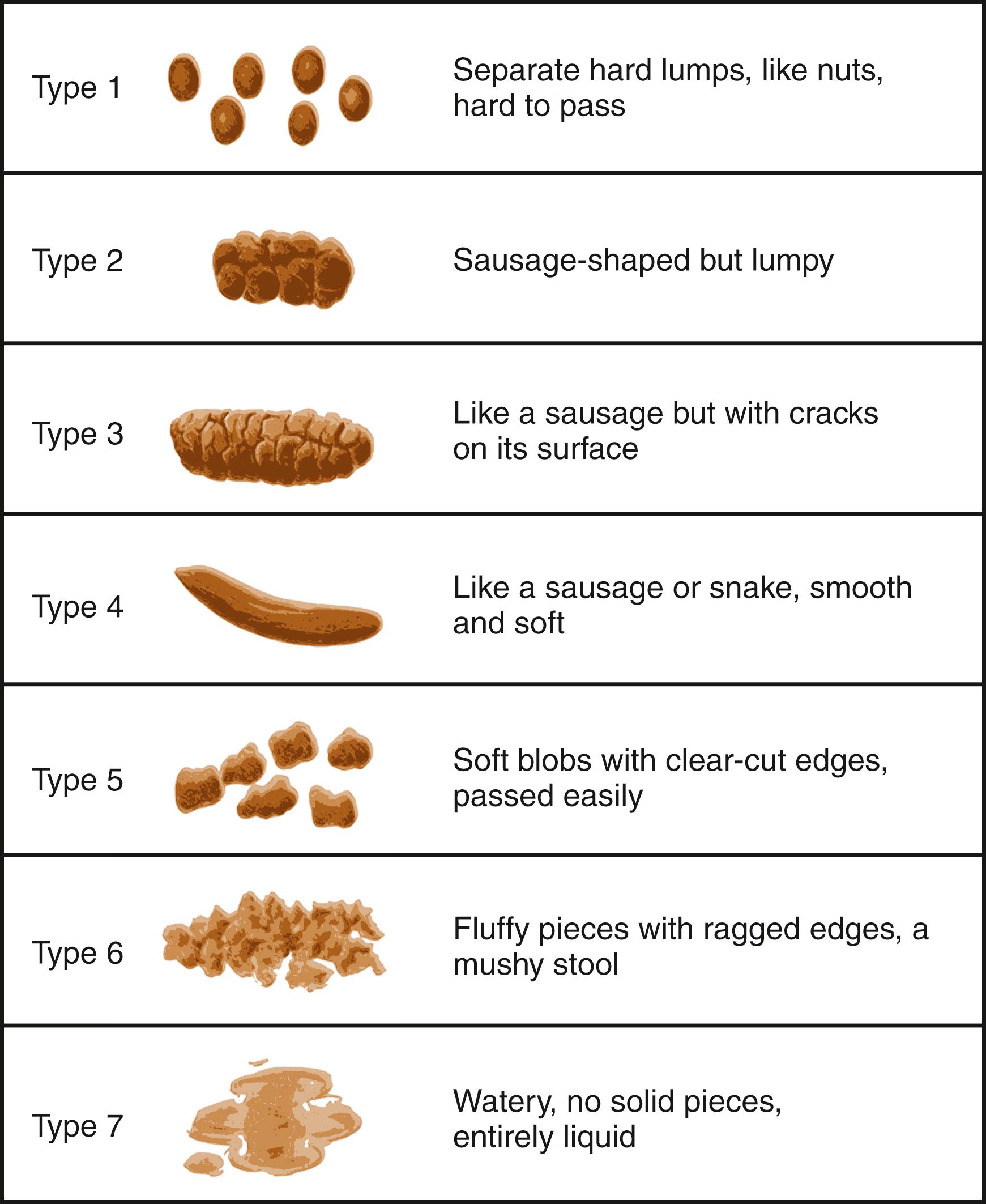 Fig. 19.1, The Bristol stool chart allows for qualitative comparisons of stool consistency in the setting of both constipation and diarrhea.